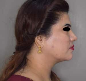 Double Chin Liposuction