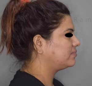 Double Chin Liposuction