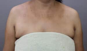 Axillary Tail of Breast