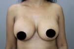 Breast Implants (Breast Augmentation)