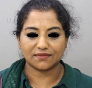 Double Chin Liposuction