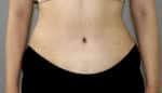 Tummy Tuck