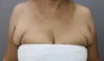 Axillary Tail of Breast