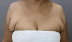 Axillary Tail of Breast