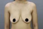 Breast Implants (Breast Augmentation)