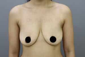Breast Implants (Breast Augmentation)