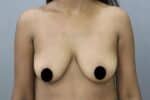 Breast Implants (Breast Augmentation)