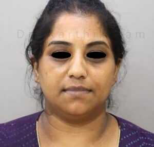 Double Chin Liposuction