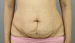 Tummy Tuck