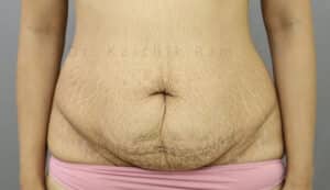 Tummy Tuck