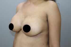Breast Implants (Breast Augmentation)