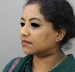 Double Chin Liposuction