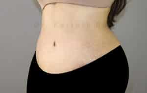 Tummy Tuck