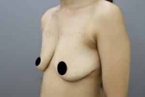 Breast Implants (Breast Augmentation)