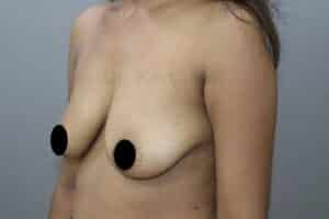 Breast Implants (Breast Augmentation)