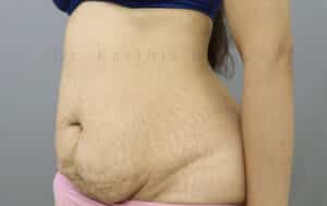 Tummy Tuck