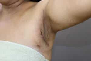 Axillary Tail of Breast