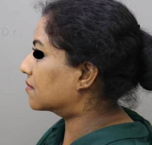 Double Chin Liposuction