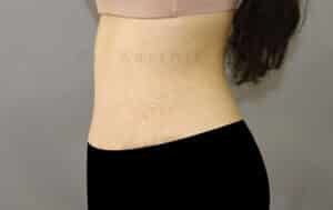 Tummy Tuck