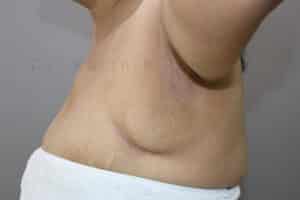Axillary Tail of Breast