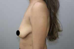 Breast Implants (Breast Augmentation)