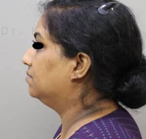 Double Chin Liposuction