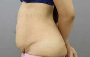 Tummy Tuck