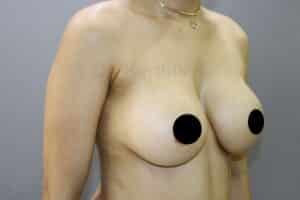 Breast Implants (Breast Augmentation)