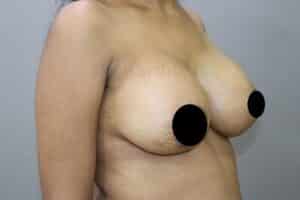 Breast Implants (Breast Augmentation)
