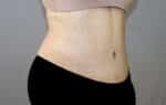 Tummy Tuck