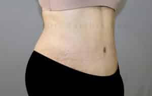 Tummy Tuck