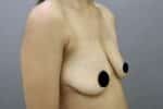 Breast Implants (Breast Augmentation)