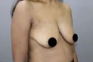 Breast Implants (Breast Augmentation)