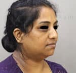 Double Chin Liposuction