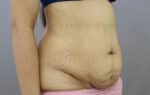 Tummy Tuck