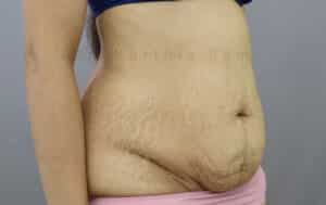 Tummy Tuck