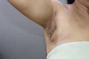 Axillary Tail of Breast