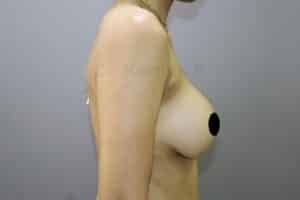 Breast Implants (Breast Augmentation)