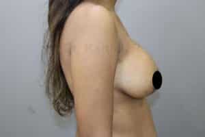 Breast Implants (Breast Augmentation)