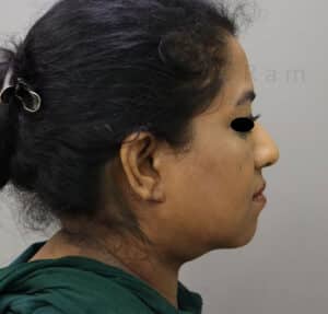 Double Chin Liposuction
