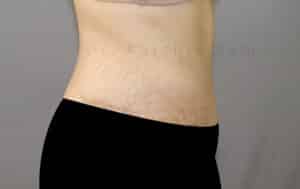 Tummy Tuck