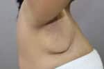 Axillary Tail of Breast