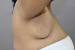 Axillary Tail of Breast