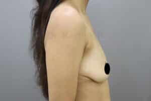 Breast Implants (Breast Augmentation)
