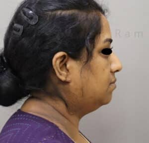 Double Chin Liposuction