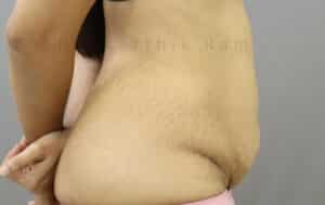 Tummy Tuck
