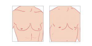 Gynecomastia