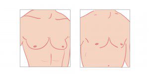 gynecomastia