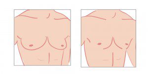 Gynecomastia