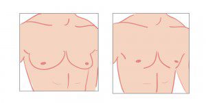 Gynecomastia